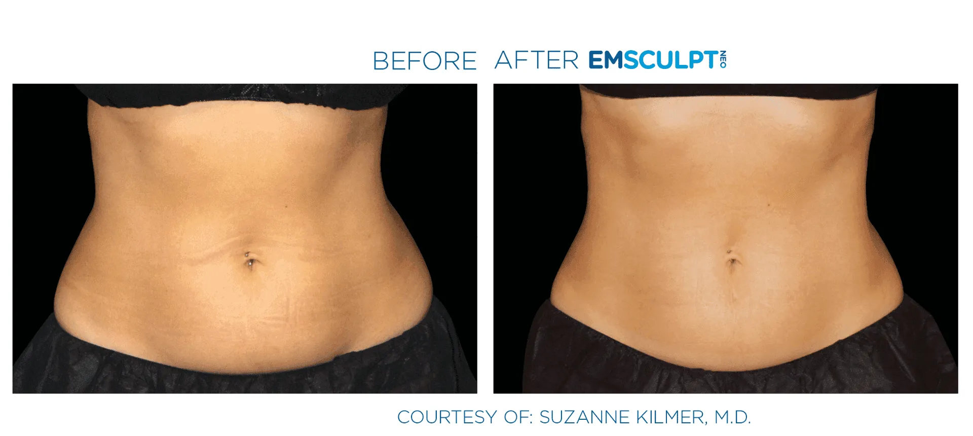 Emsculpt Neo effect on abdomen