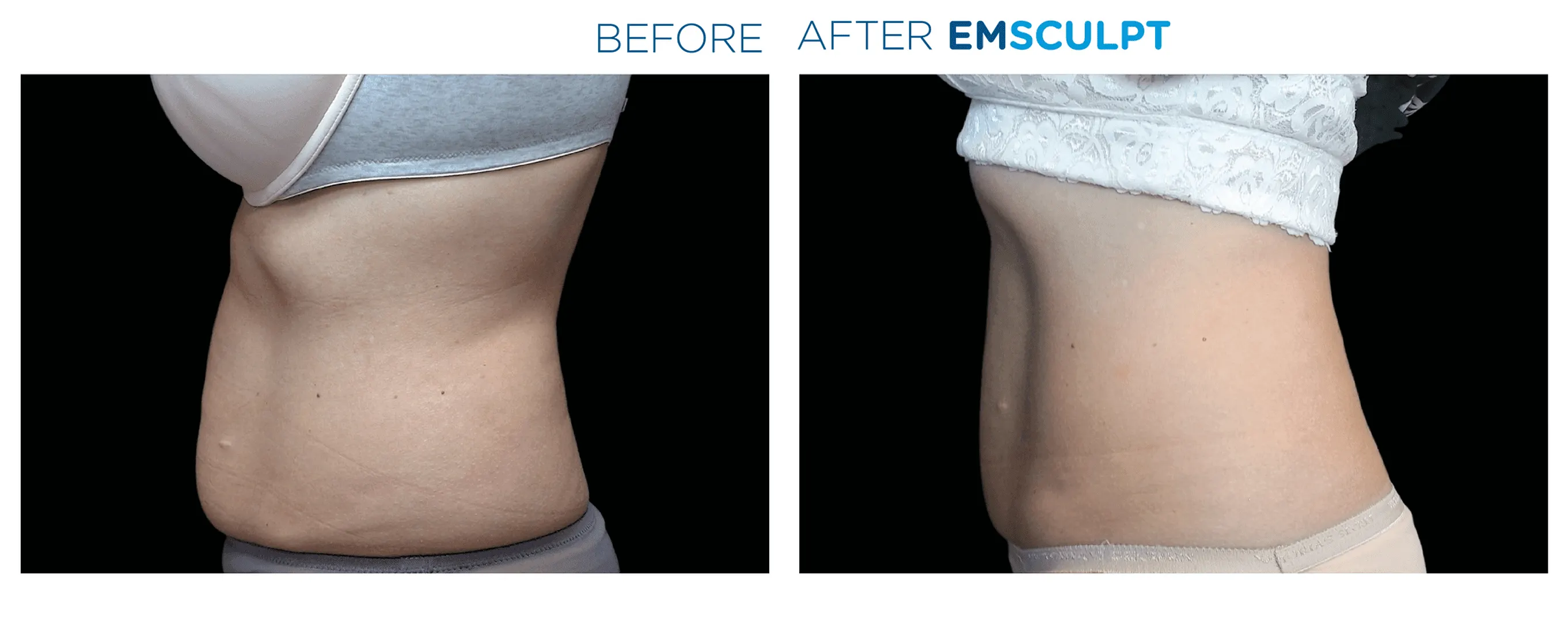Emsculpt before and after