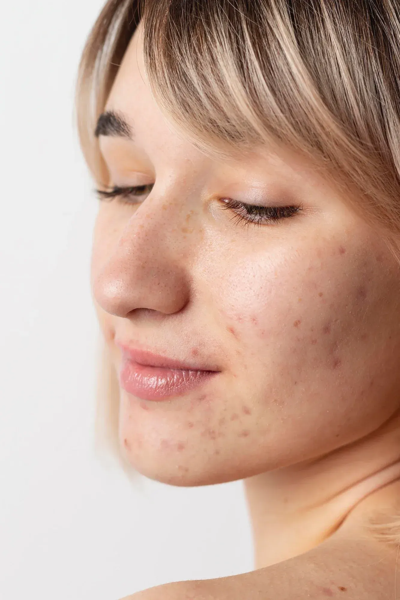 Close-up showing acne scarring and uneven skin texture at Heritage Wellness & Med Spa Crescent Springs
