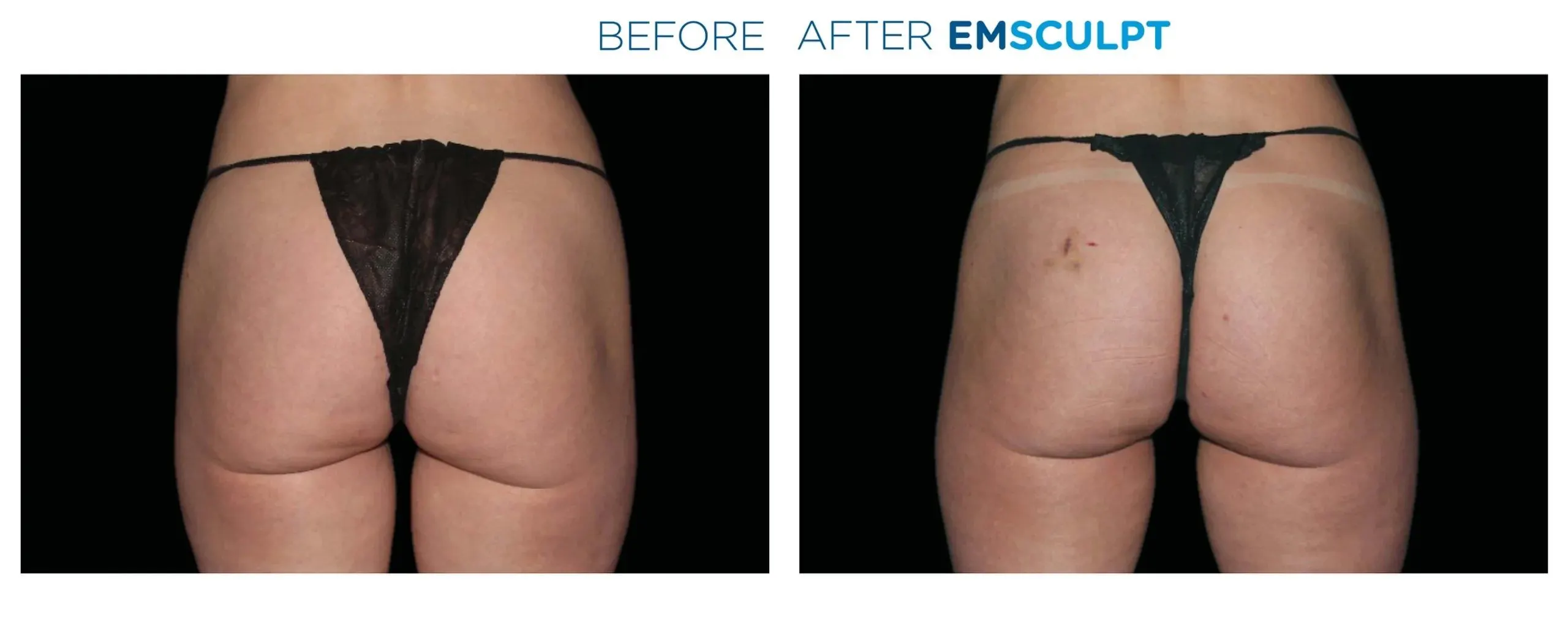 Emsculpt in Crescent Springs before and after