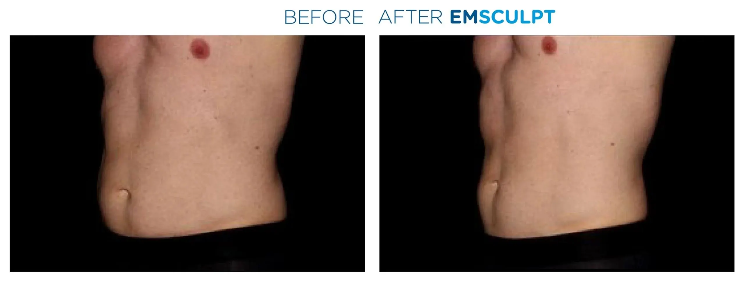 Emsculpt in Crescent Springs before and after