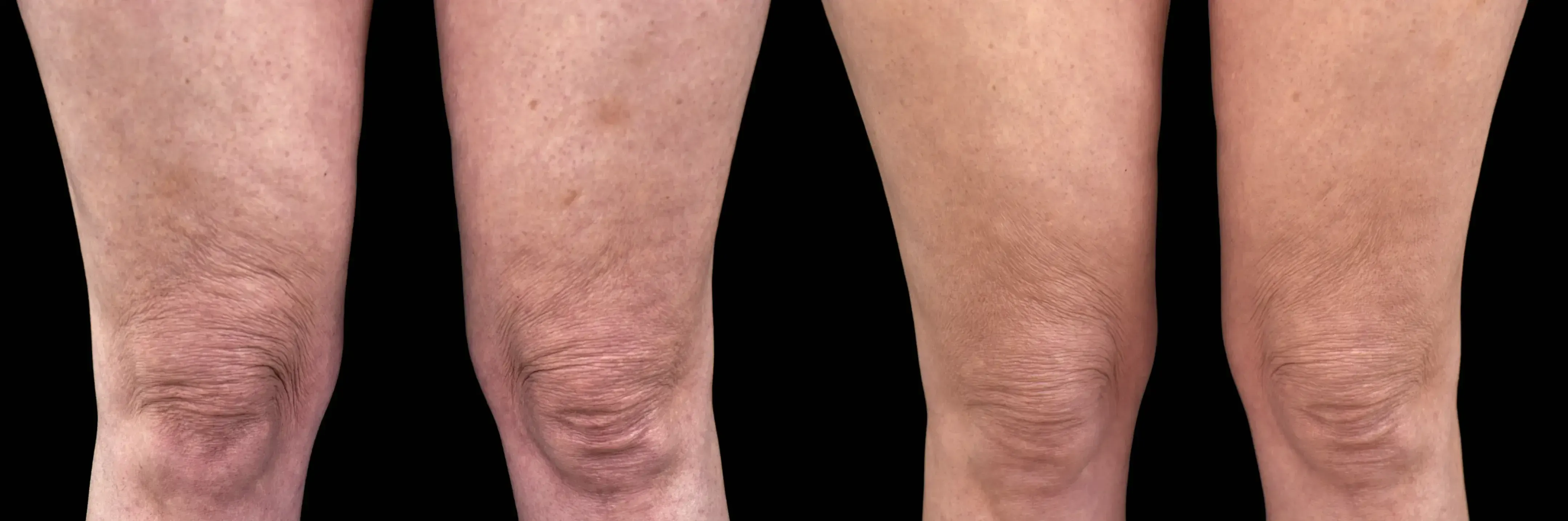 Emtone in Crescent Springs before and after