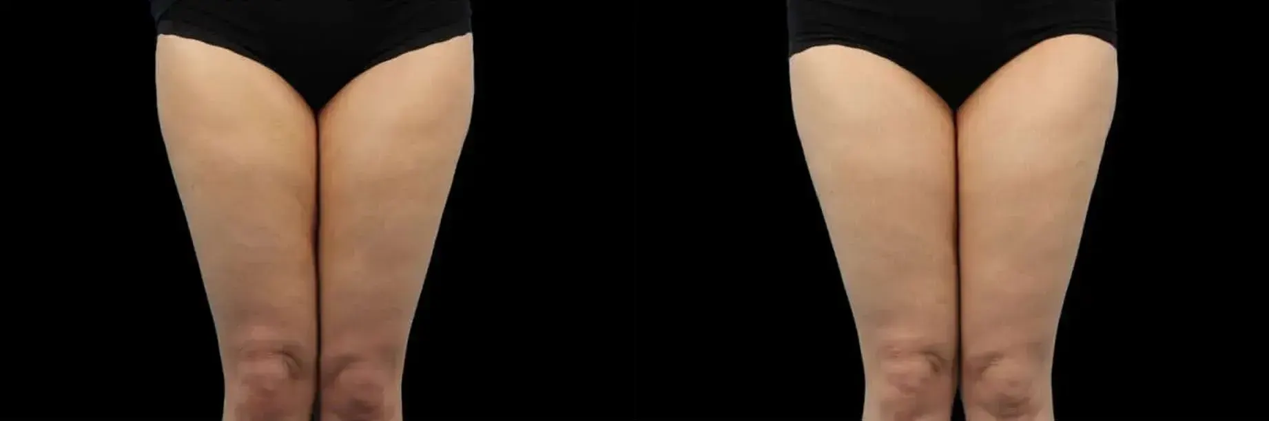 Emtone in Crescent Springs before and after
