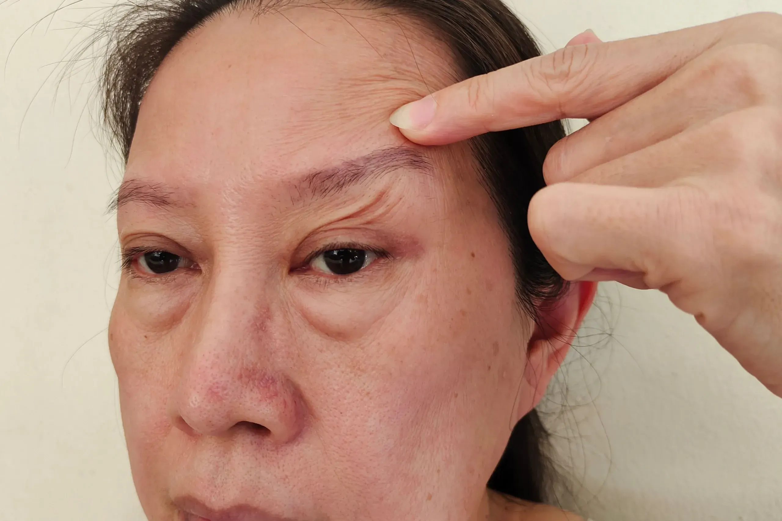 Illustration of collagen and elastin breakdown in dermis at Heritage Wellness & Med Spa Crescent Springs