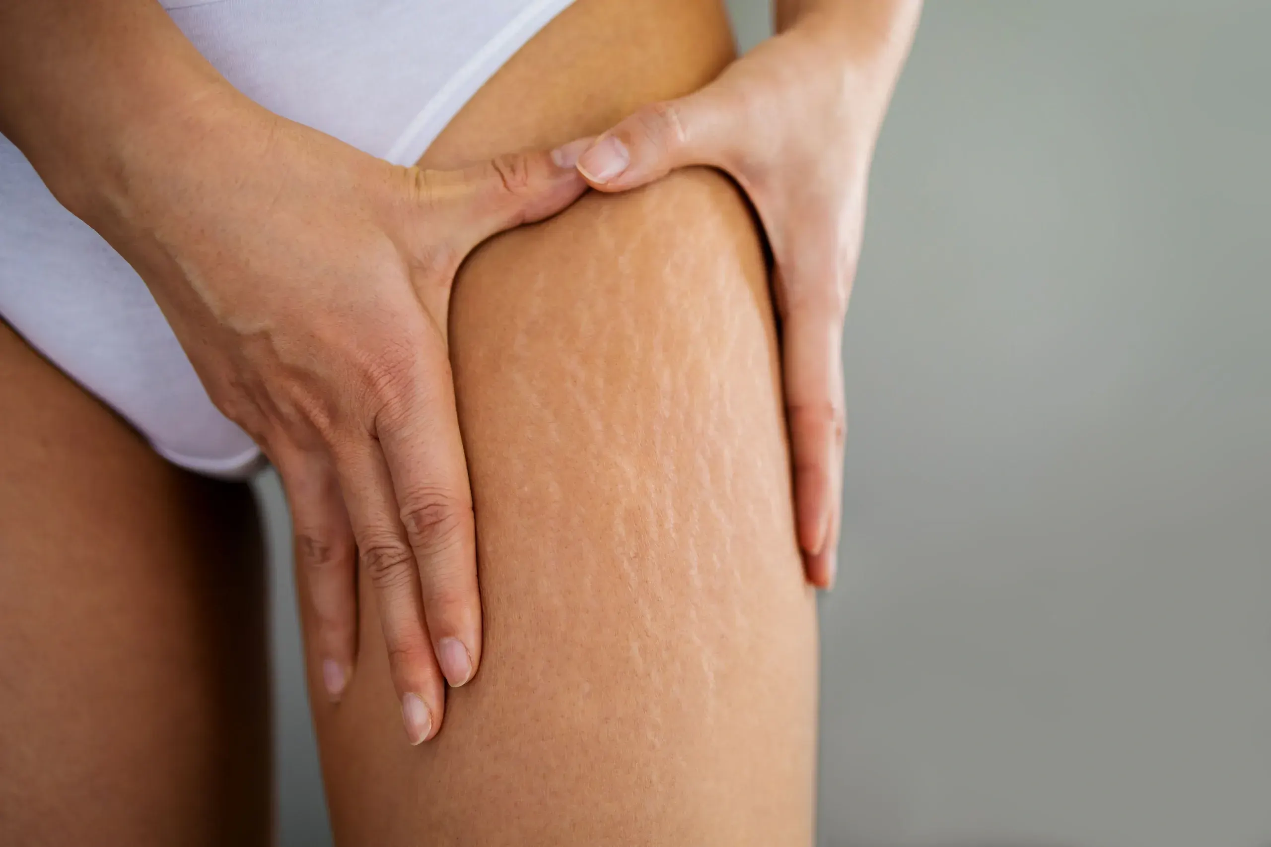 Patient examining stretch marks at Heritage Wellness & Med Spa Crescent Springs