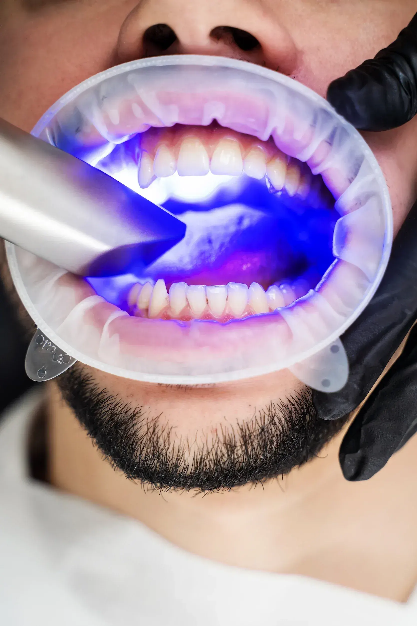 Who Is a Good Candidate for Teeth Whitening?