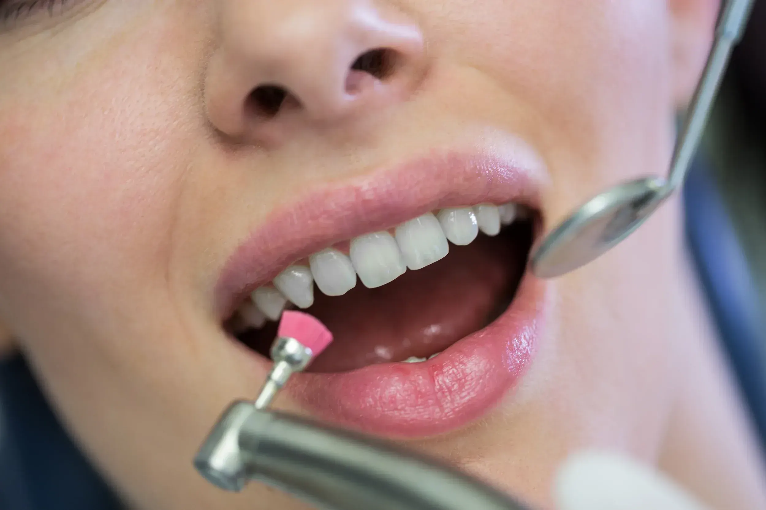 Professional in-office teeth whitening at Heritage Wellness & Med Spa in Crescent Springs, KY