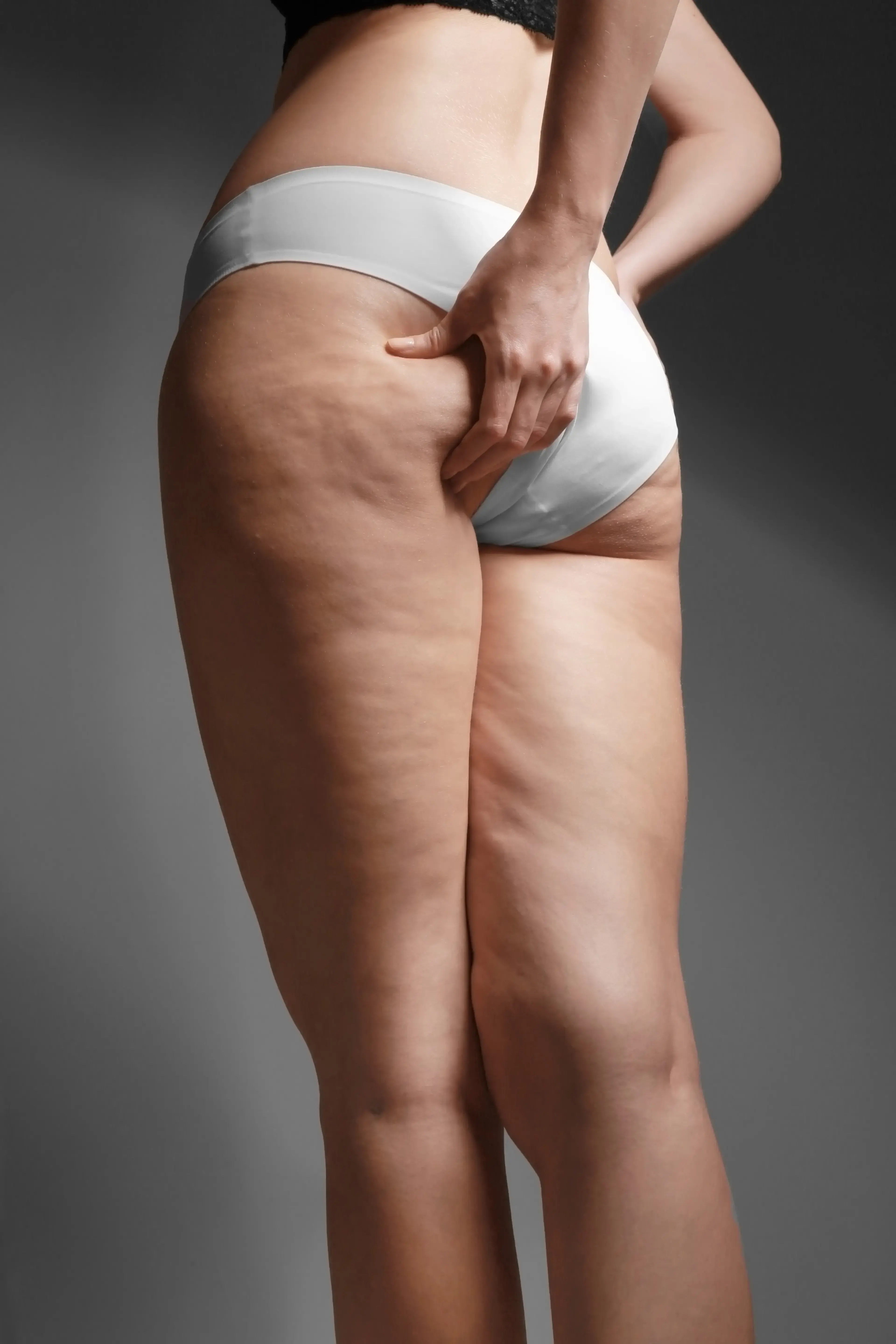 Illustration of fibrotic septae and fat chambers at Heritage Wellness & Med Spa Crescent Springs