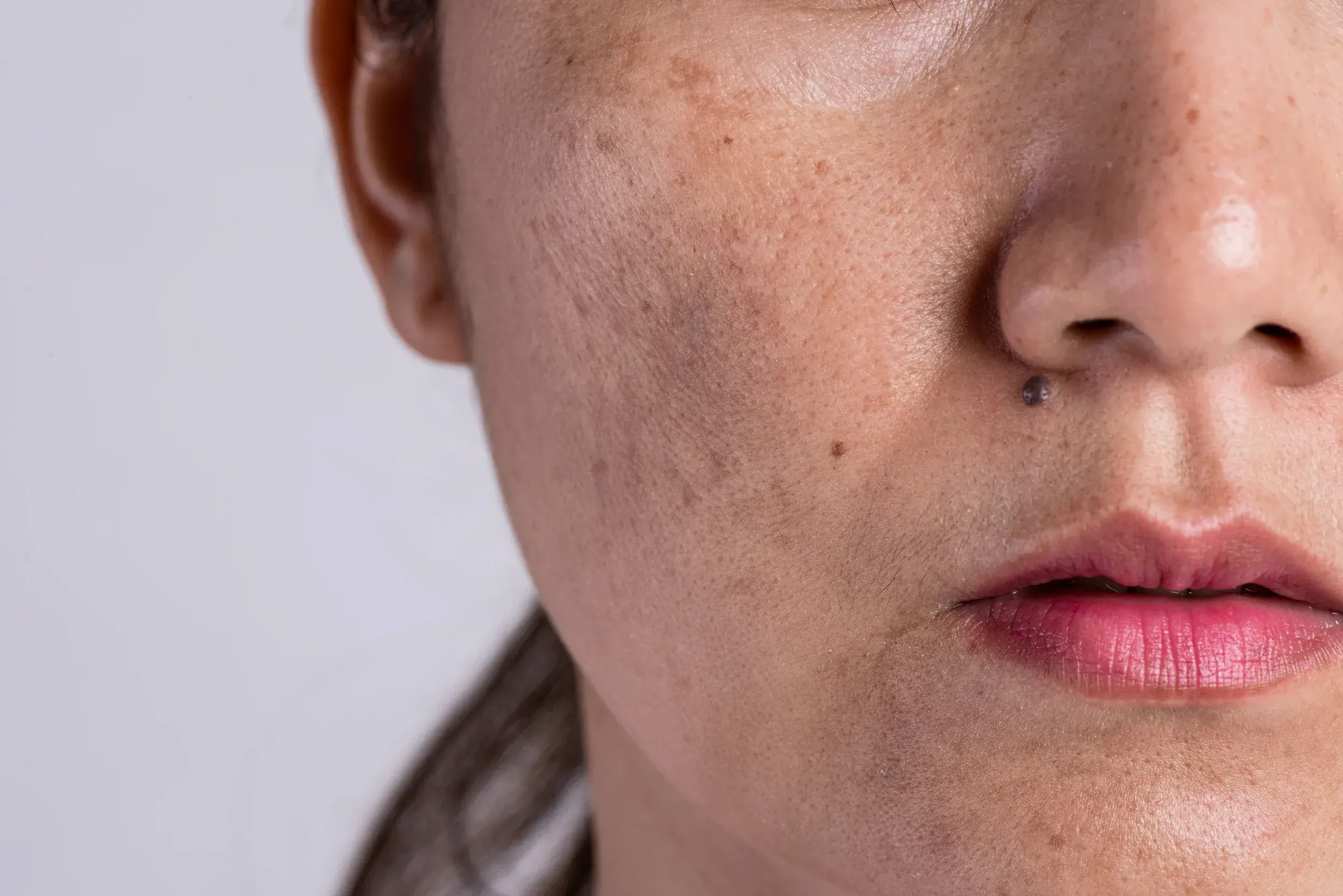 Lifestyle factors that worsen acne scars at Heritage Wellness & Med Spa Crescent Springs