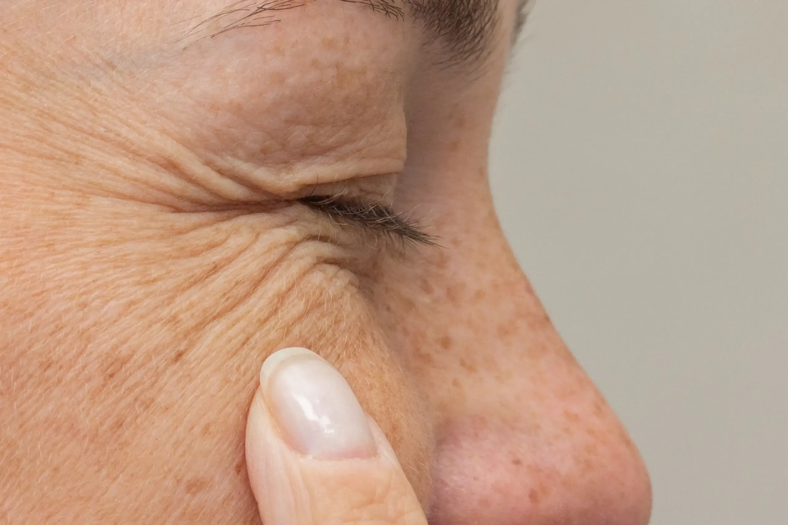 Comparison of dynamic and static wrinkles at Heritage Wellness & Med Spa Crescent Springs