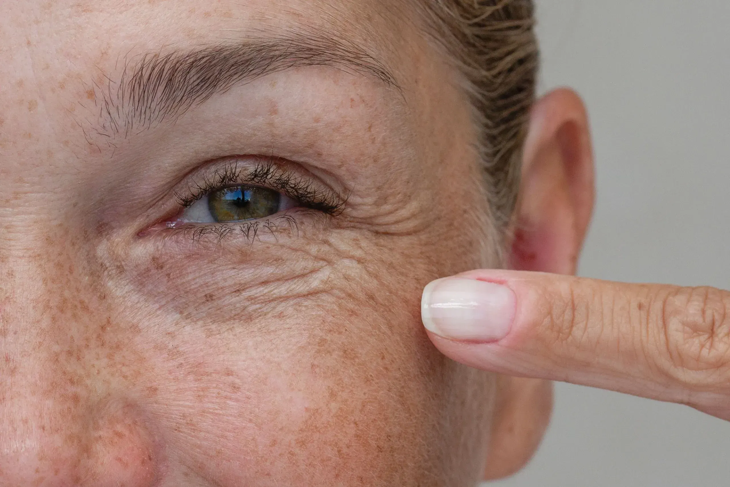 Close-up of fine lines and wrinkles around the eyes at Heritage Wellness & Med Spa Crescent Springs