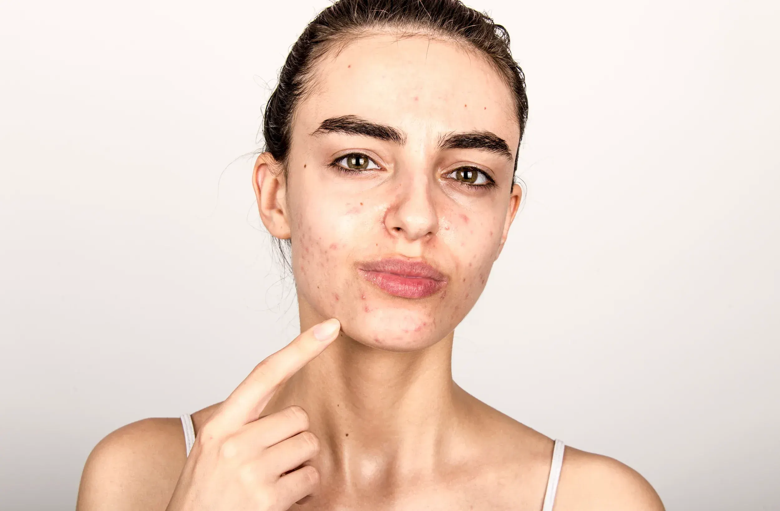 Illustration of dermal collagen damage from acne at Heritage Wellness & Med Spa Crescent Springs